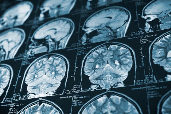 Brain Injury